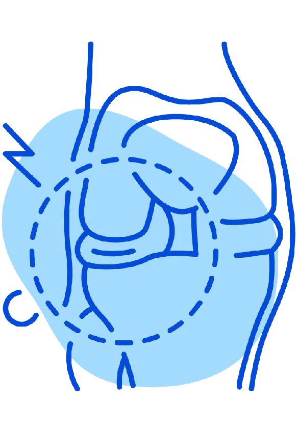 lesion de menisco
